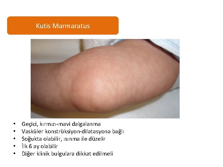 Kutis Marmaratus • • • Geçici, kırmızı-mavi dalgalanma Vasküler konstrüksiyon-dilatasyona bağlı Soğukta olabilir, ısınma