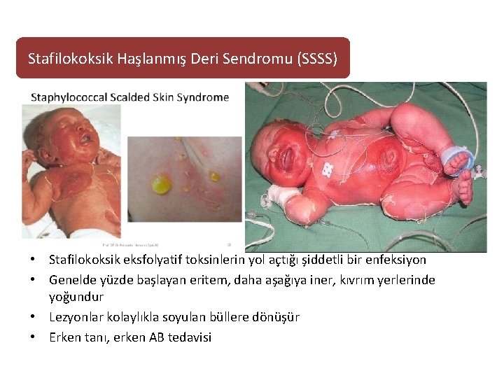 Stafilokoksik Haşlanmış Deri Sendromu (SSSS) • Stafilokoksik eksfolyatif toksinlerin yol açtığı şiddetli bir enfeksiyon