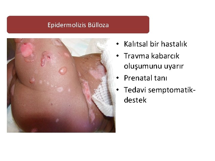 Epidermolizis Bülloza • Kalıtsal bir hastalık • Travma kabarcık oluşumunu uyarır • Prenatal tanı