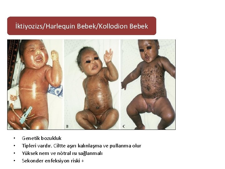 İktiyozizs/Harlequin Bebek/Kollodion Bebek • • Genetik bozukluk Tipleri vardır. Ciltte aşırı kalınlaşma ve pullanma