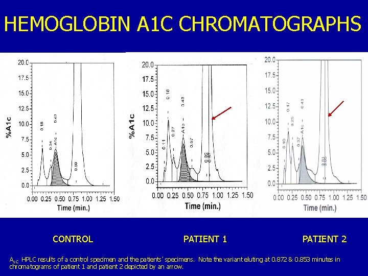 HEMOGLOBIN A 1 C CHROMATOGRAPHS CONTROL PATIENT 1 PATIENT 2 A 1 C HPLC