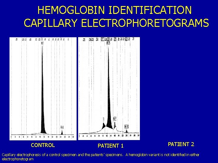 HEMOGLOBIN IDENTIFICATION CAPILLARY ELECTROPHORETOGRAMS CONTROL PATIENT 1 PATIENT 2 Capillary electrophoresis of a control