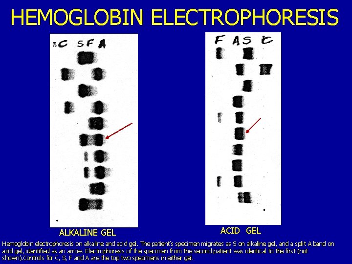 HEMOGLOBIN ELECTROPHORESIS ALKALINE GEL ACID GEL Hemoglobin electrophoresis on alkaline and acid gel. The