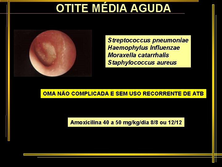 OTITE MÉDIA AGUDA Streptococcus pneumoniae Haemophylus Influenzae Moraxella catarrhalis Staphylococcus aureus OMA NÃO COMPLICADA