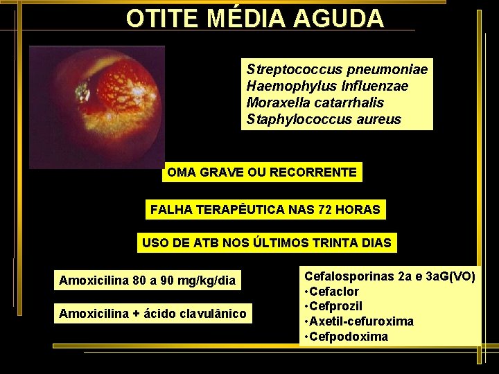 OTITE MÉDIA AGUDA Streptococcus pneumoniae Haemophylus Influenzae Moraxella catarrhalis Staphylococcus aureus OMA GRAVE OU