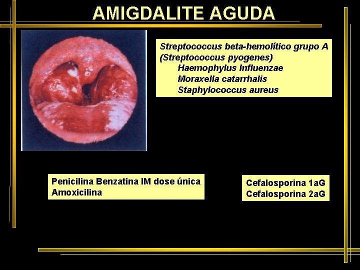 AMIGDALITE AGUDA Streptococcus beta-hemolítico grupo A (Streptococcus pyogenes) Haemophylus Influenzae Moraxella catarrhalis Staphylococcus aureus