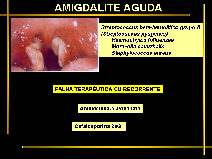 AMIGDALITE AGUDA Streptococcus beta-hemolítico grupo A (Streptococcus pyogenes) Haemophylus Influenzae Moraxella catarrhalis Staphylococcus aureus