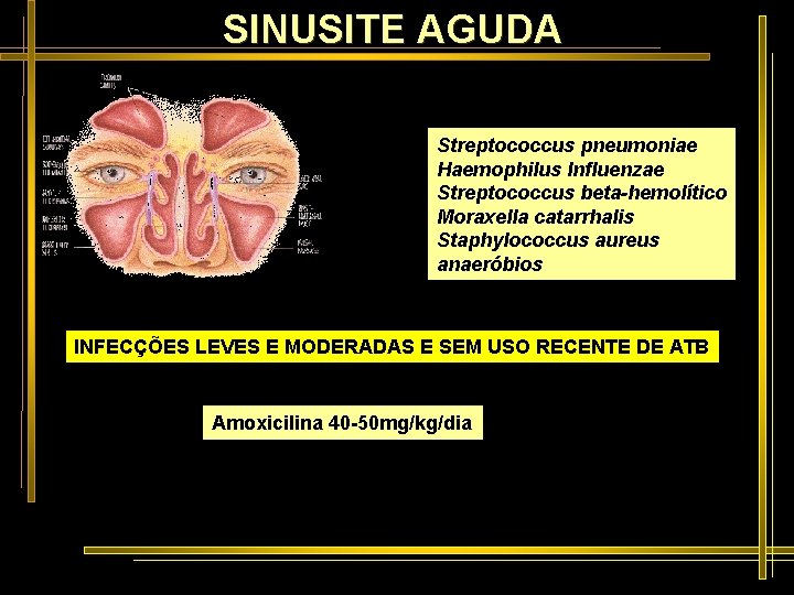 SINUSITE AGUDA Streptococcus pneumoniae Haemophilus Influenzae Streptococcus beta-hemolítico Moraxella catarrhalis Staphylococcus aureus anaeróbios INFECÇÕES