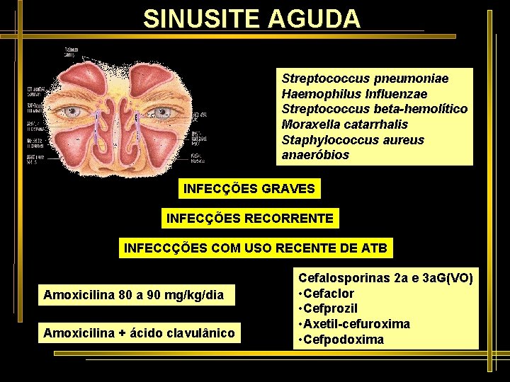 SINUSITE AGUDA Streptococcus pneumoniae Haemophilus Influenzae Streptococcus beta-hemolítico Moraxella catarrhalis Staphylococcus aureus anaeróbios INFECÇÕES