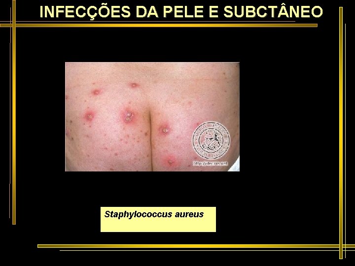 INFECÇÕES DA PELE E SUBCT NEO Staphylococcus aureus 