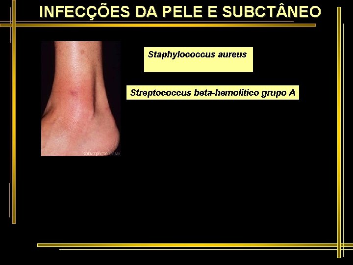 INFECÇÕES DA PELE E SUBCT NEO Staphylococcus aureus Streptococcus beta-hemolítico grupo A 