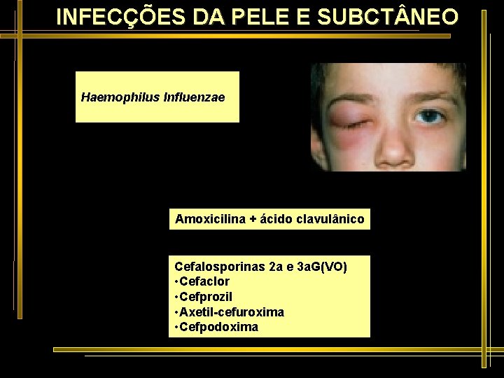 INFECÇÕES DA PELE E SUBCT NEO Haemophilus Influenzae Amoxicilina + ácido clavulânico Cefalosporinas 2