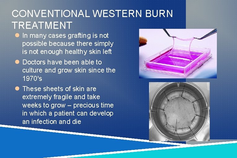 CONVENTIONAL WESTERN BURN TREATMENT In many cases grafting is not possible because there simply CONVENTIONAL WESTERN BURN TREATMENT In many cases grafting is not possible because there simply