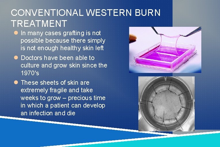 CONVENTIONAL WESTERN BURN TREATMENT In many cases grafting is not possible because there simply