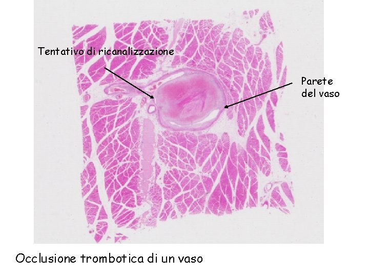 Tentativo di ricanalizzazione Parete del vaso Occlusione trombotica di un vaso 