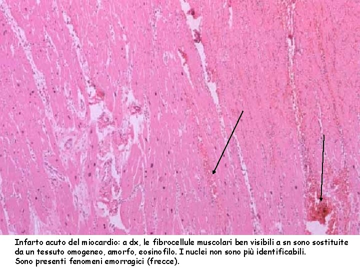 Infarto acuto del miocardio: a dx, le fibrocellule muscolari ben visibili a sn sono