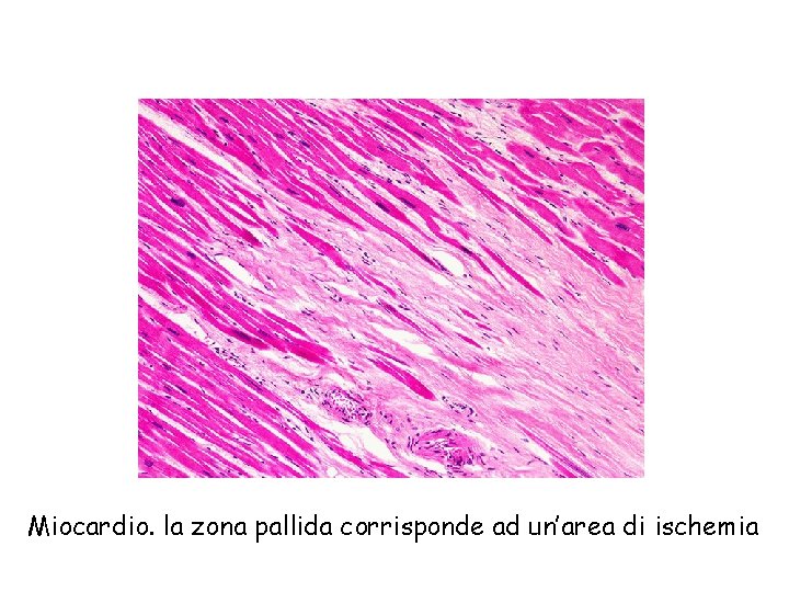 Miocardio. la zona pallida corrisponde ad un’area di ischemia 