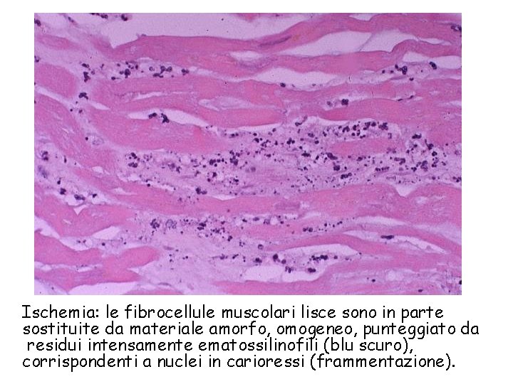 Ischemia: le fibrocellule muscolari lisce sono in parte sostituite da materiale amorfo, omogeneo, punteggiato