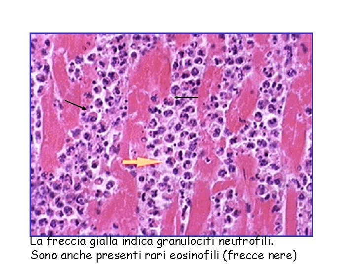 La freccia gialla indica granulociti neutrofili. Sono anche presenti rari eosinofili (frecce nere) 