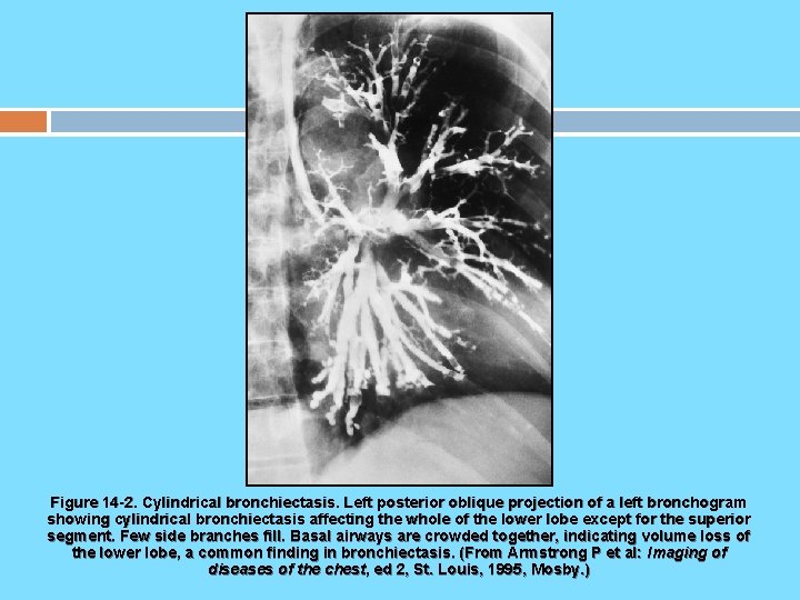 Figure 14 -2. Cylindrical bronchiectasis. Left posterior oblique projection of a left bronchogram showing