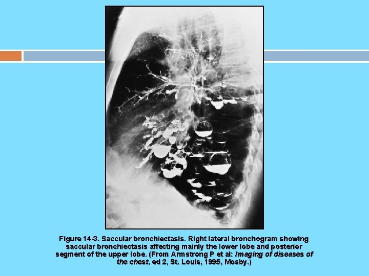 Figure 14 -3. Saccular bronchiectasis. Right lateral bronchogram showing saccular bronchiectasis affecting mainly the