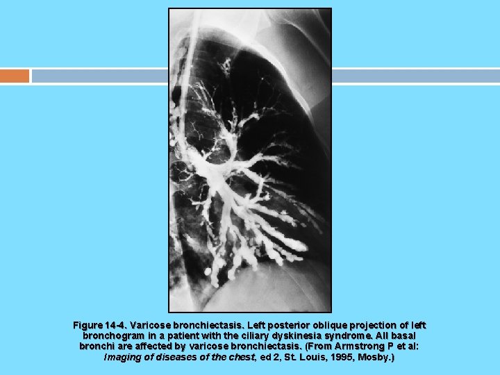 Figure 14 -4. Varicose bronchiectasis. Left posterior oblique projection of left bronchogram in a