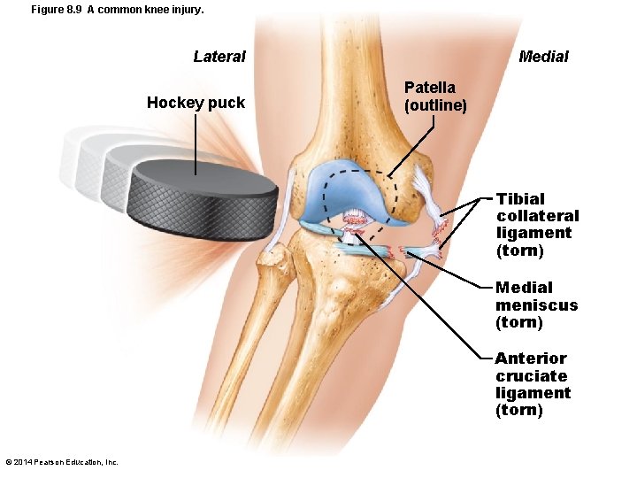 Figure 8. 9 A common knee injury. Lateral Hockey puck Medial Patella (outline) Tibial