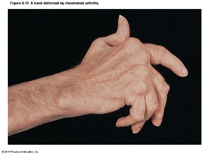 Figure 8. 15 A hand deformed by rheumatoid arthritis. © 2014 Pearson Education, Inc.