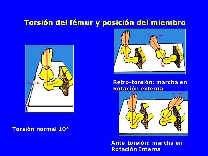 Torsión del fémur y posición del miembro Retro-torsión: marcha en Rotación externa Torsión normal