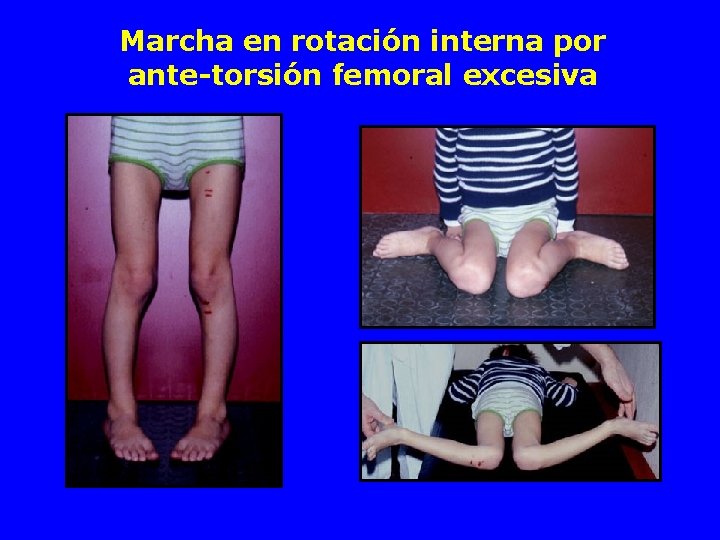 Marcha en rotación interna por ante-torsión femoral excesiva 