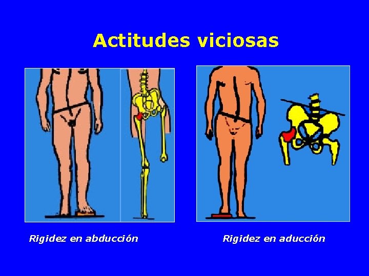 Actitudes viciosas Rigidez en abducción Rigidez en aducción 