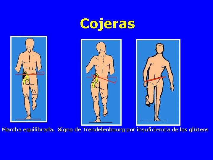 Cojeras Marcha equilibrada. Signo de Trendelenbourg por insuficiencia de los glúteos 