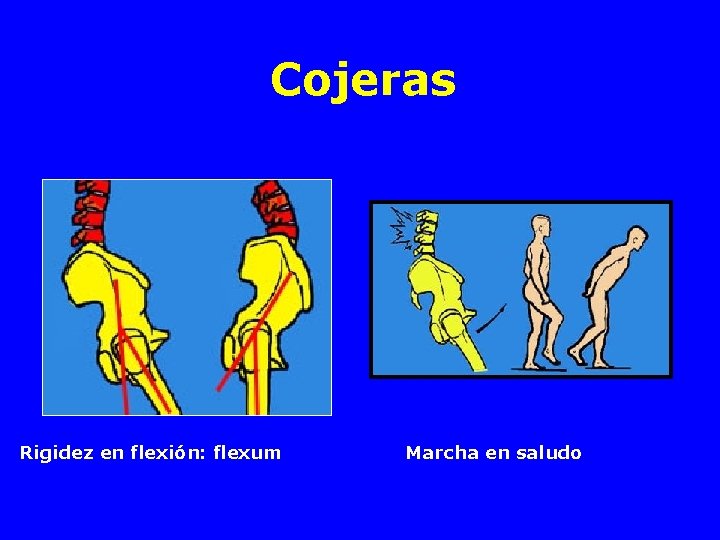 Cojeras Rigidez en flexión: flexum Marcha en saludo 