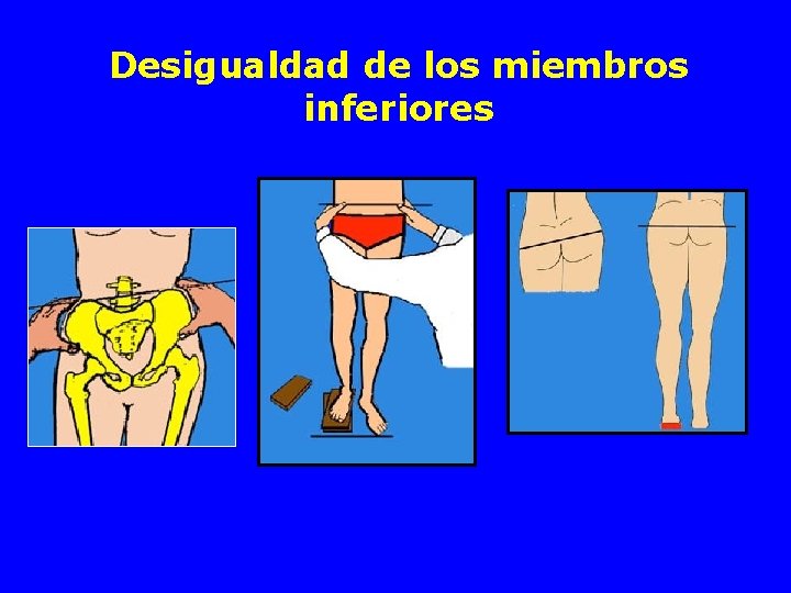 Desigualdad de los miembros inferiores 