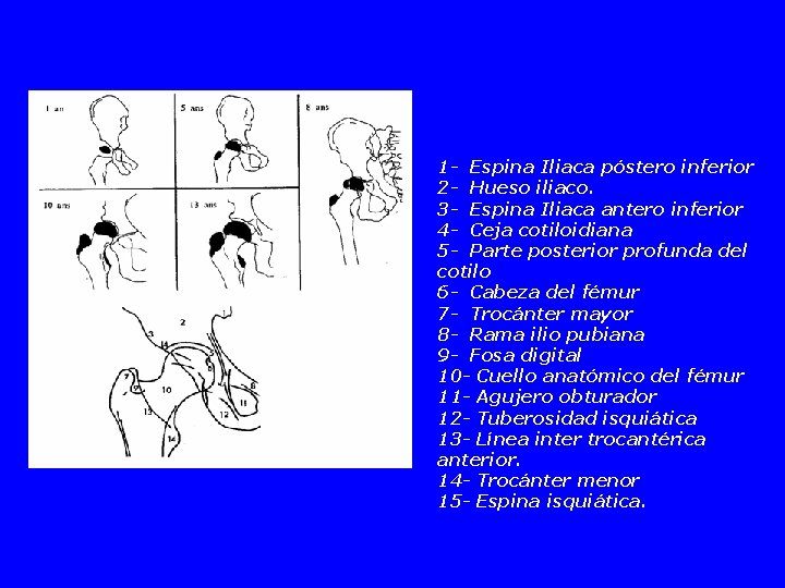 1 - Espina Iliaca póstero inferior 2 - Hueso iliaco. 3 - Espina Iliaca