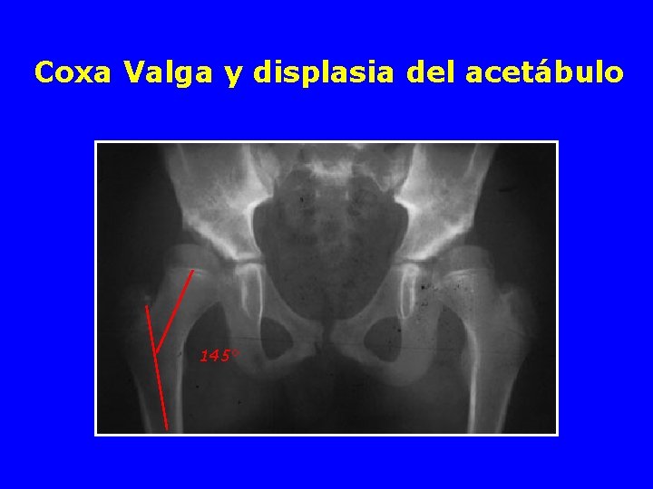 Coxa Valga y displasia del acetábulo 145° 