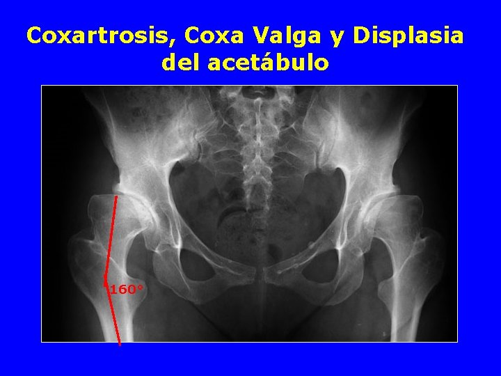 Coxartrosis, Coxa Valga y Displasia del acetábulo 160° 