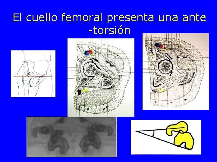 El cuello femoral presenta una ante -torsión 