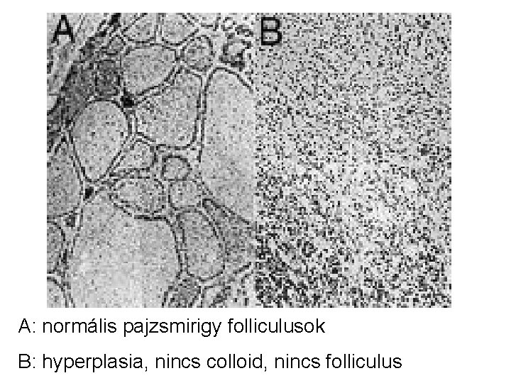 A: normális pajzsmirigy folliculusok B: hyperplasia, nincs colloid, nincs folliculus 