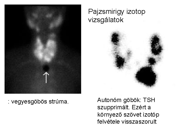 Pajzsmirigy izotop vizsgálatok : vegyesgöbös strúma. Autonóm göbök: TSH szupprimált. Ezért a környező szövet