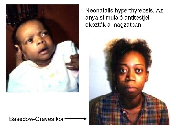 Neonatalis hyperthyreosis. Az anya stimuláló antitestjei okozták a magzatban Basedow-Graves kór 