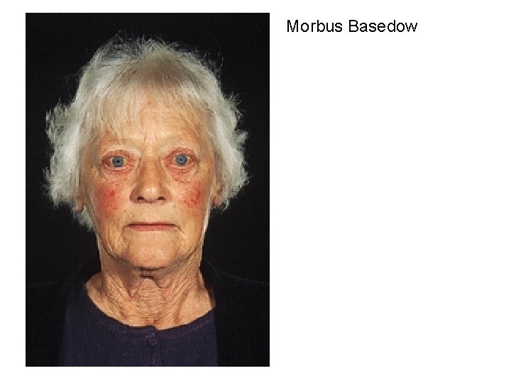 Morbus Basedow 