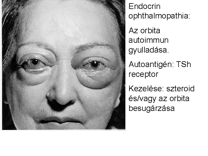 Endocrin ophthalmopathia: Az orbita autoimmun gyulladása. Autoantigén: TSh receptor Kezelése: szteroid és/vagy az orbita