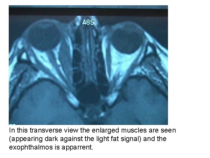 In this transverse view the enlarged muscles are seen (appearing dark against the light