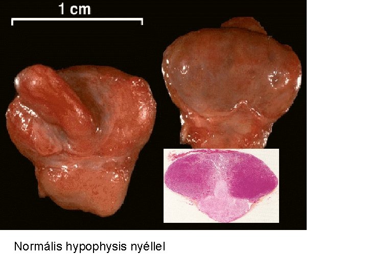 Normális hypophysis nyéllel 