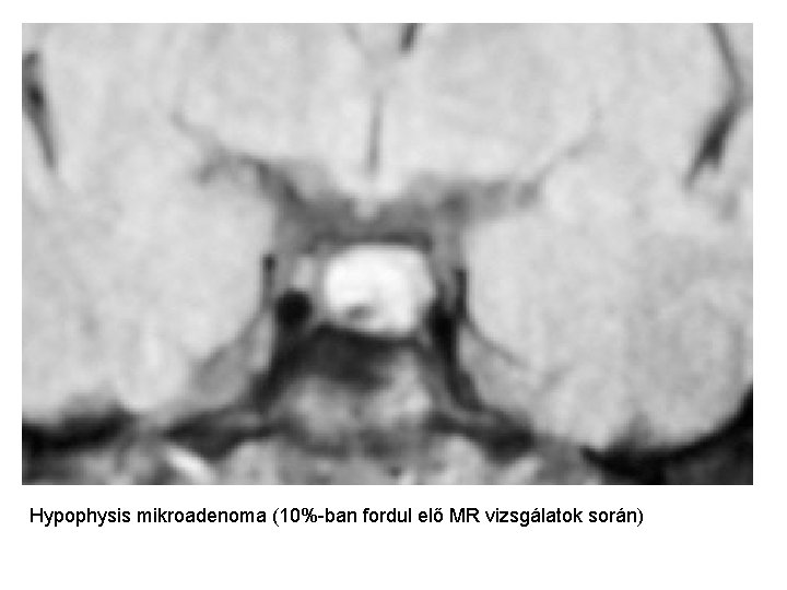 Hypophysis mikroadenoma (10%-ban fordul elő MR vizsgálatok során) 