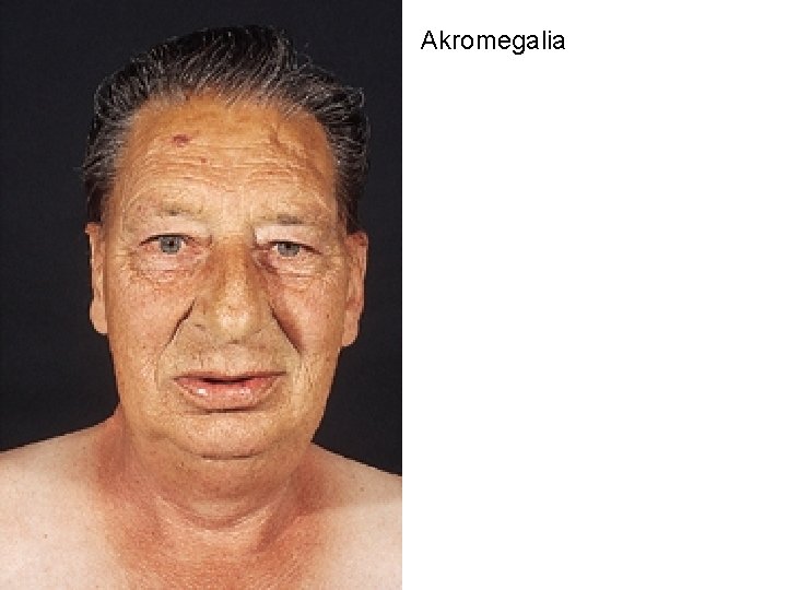 Akromegalia 