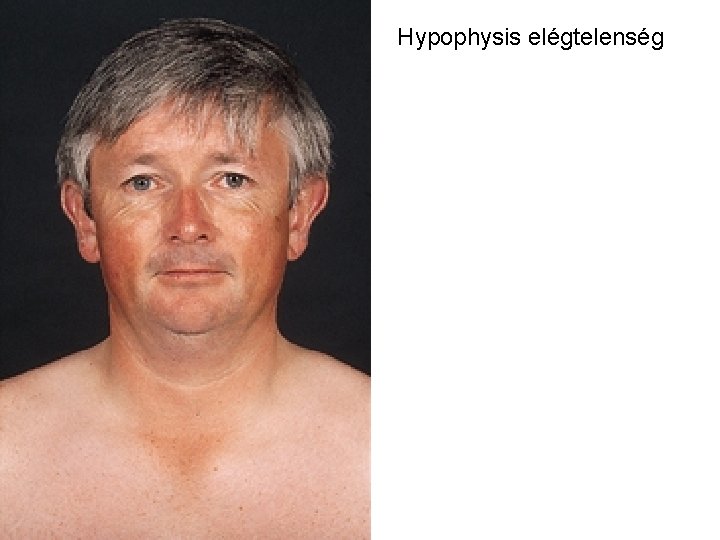 Hypophysis elégtelenség 