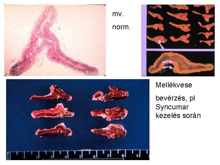 mv. norm. Mellékvese bevérzés, pl Syncumar kezelés során 