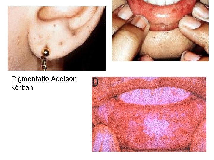 Pigmentatio Addison kórban 